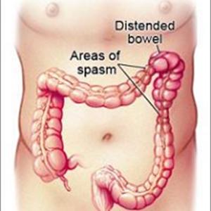 Digestive Advantage Ibs Tablets - Information About Irritable Bowel Syndrome